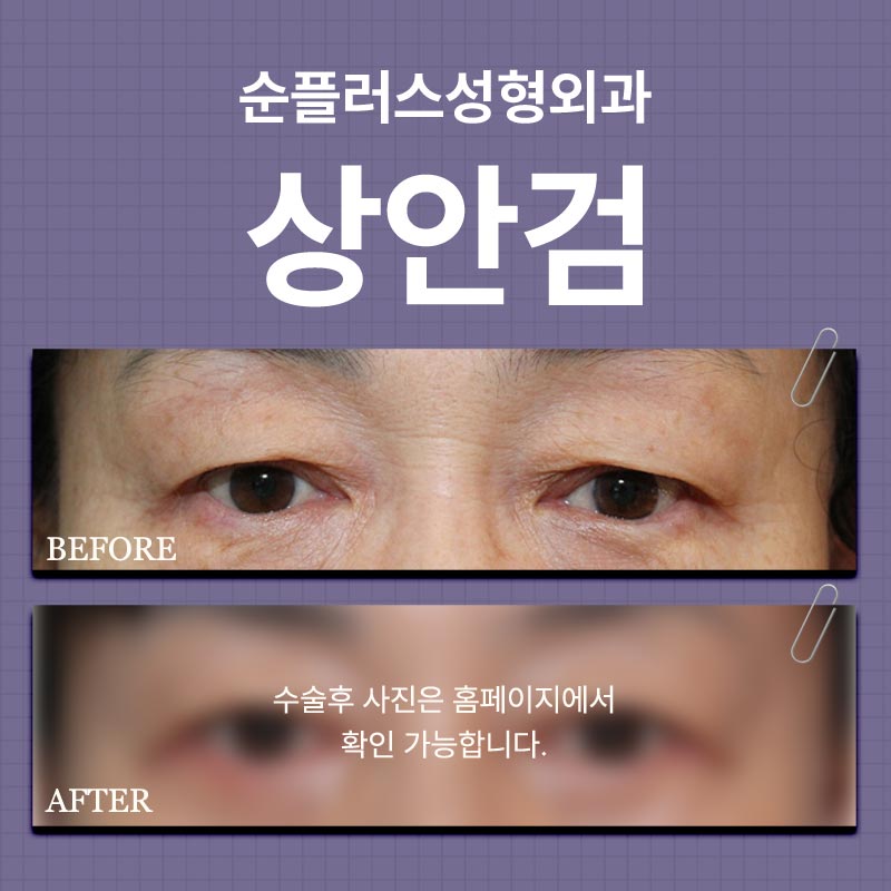 Middle-Aged Double Eyelid Surgery, Also Known as Midlife Double Eyelid Surgery, Improves Drooping Eyelids image 5