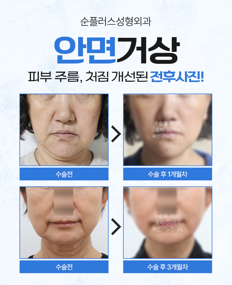 안면거상술 왜 필요한가? 효과, 수술방법, 주의사항까지 관련 이미지 7
