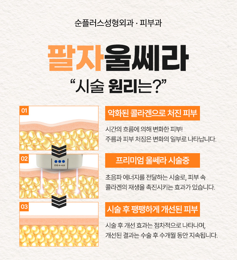 팔자주름, 울쎄라 레이저로 리프팅해 볼륨과 탄력 효과를 관련 이미지 4
