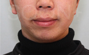 경계가 불분명한 턱끝, 무턱수술 플랜이 필요할때 관련 이미지 6