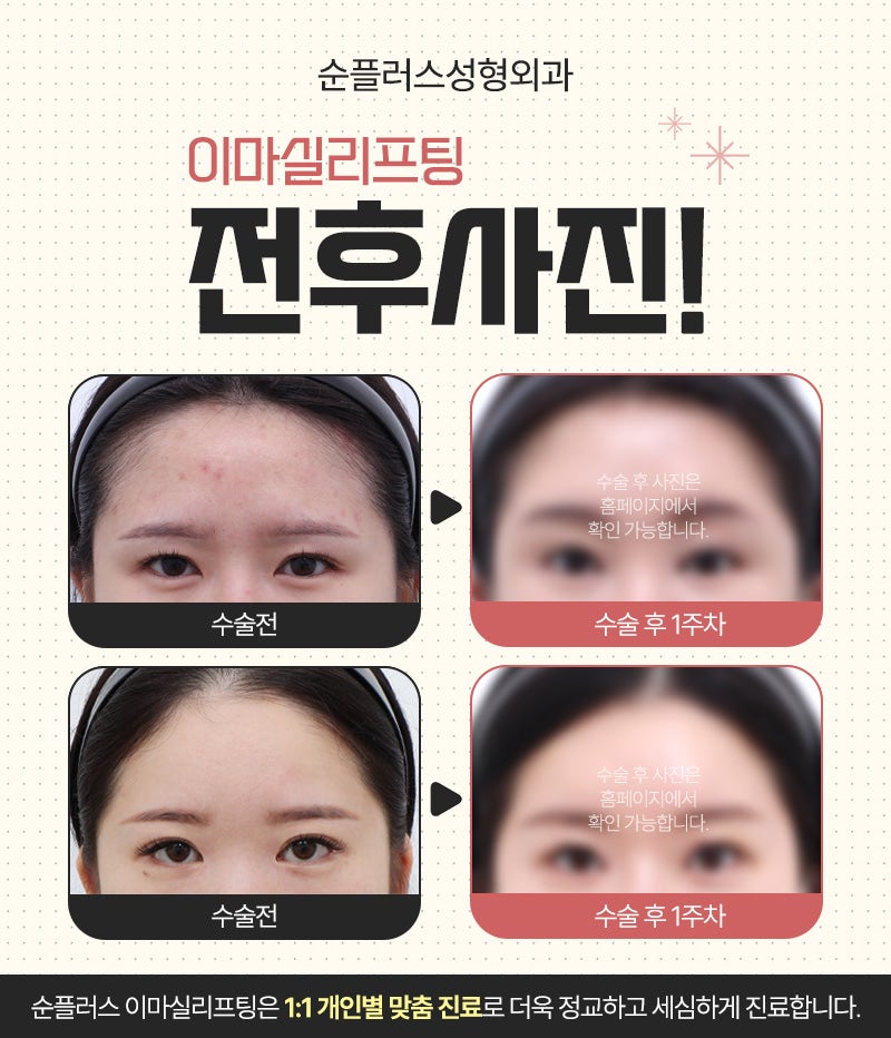 답답해 보이는 눈 이마실리프팅으로 교정될까? 관련 이미지 6