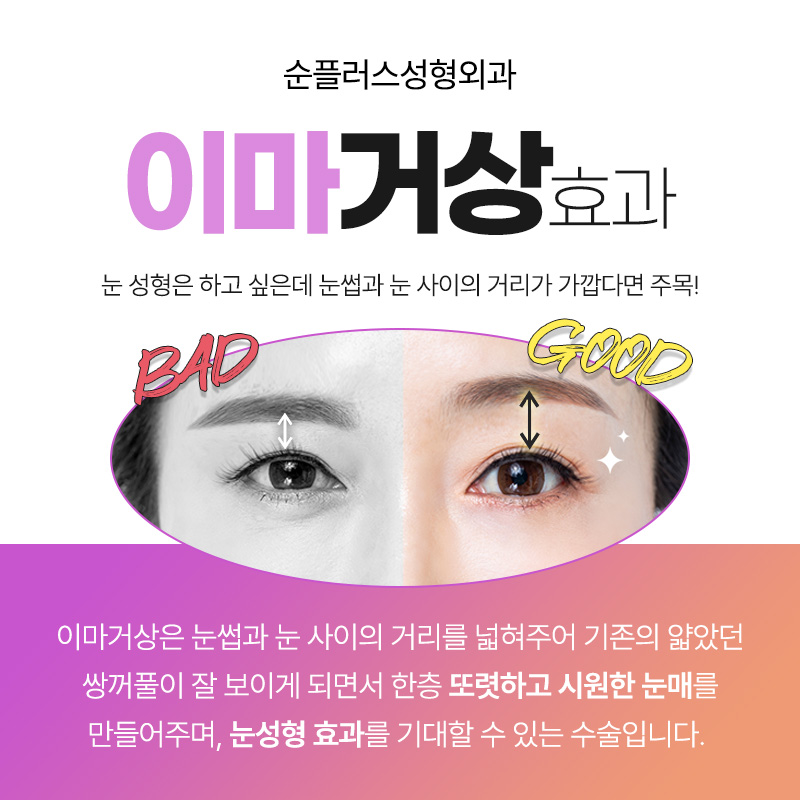 Is forehead lift only recommended for people in their 40s and 50s, and not recommended for people in their 20s and 30s? image 4