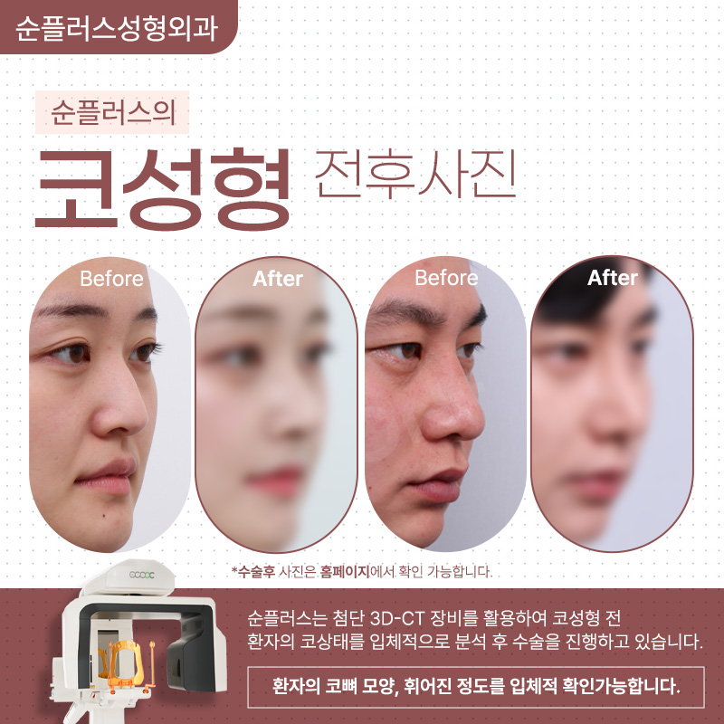 강남 코수술잘하는곳 균형과 비율에 맞춰 관련 이미지 5