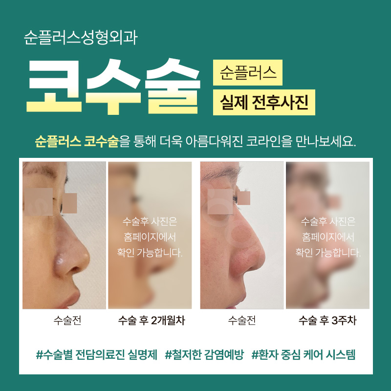 Rhinoplasty Surgery: The Right Process Matters image 4