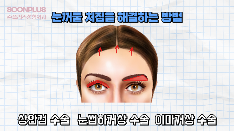 What Surgery Is Performed to Improve Drooping Eyelids and Sagging Eyes, Even by Celebrities? image 1