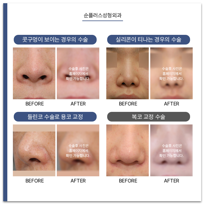 Before Choosing Revision Rhinoplasty image 5