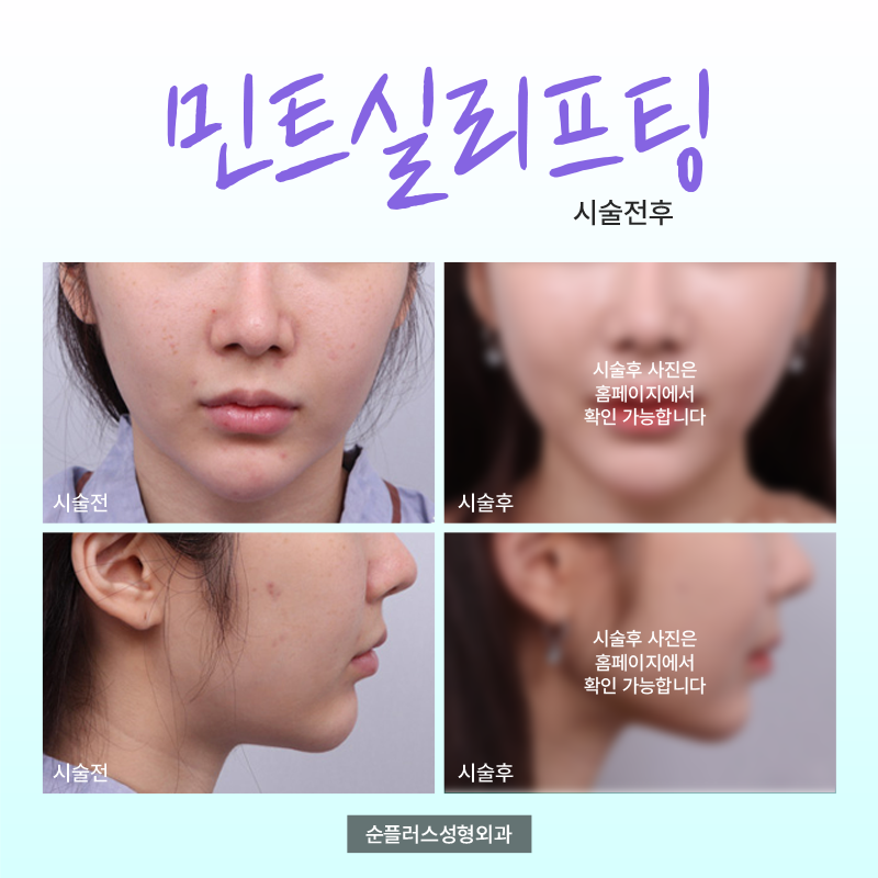 강남 신사역 민트 실리프팅 맞춤 방향과 각도로 관련 이미지 5