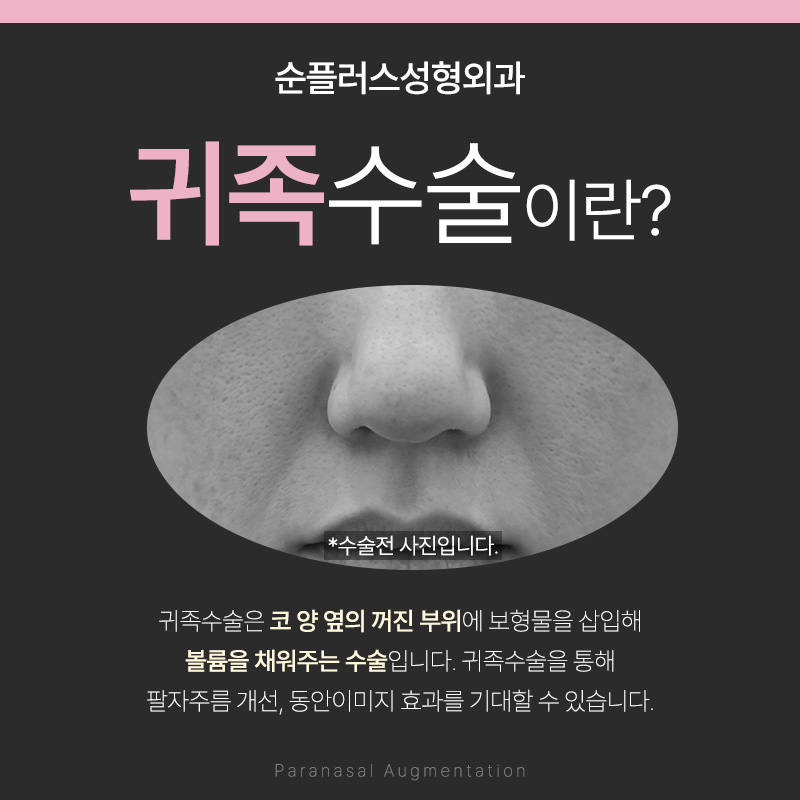 If You Want Natural Improvement of Nasolabial Folds and a Short Recovery Period, Consider Noble Surgery Using an Implant image 2