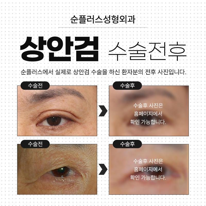 처진눈수술 늘어진 피부 개선으로 선명한 인상과 시야확보까지 관련 이미지 5