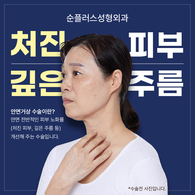 안면거상잘하는곳 핵심 포인트까지 확인 관련 이미지 2