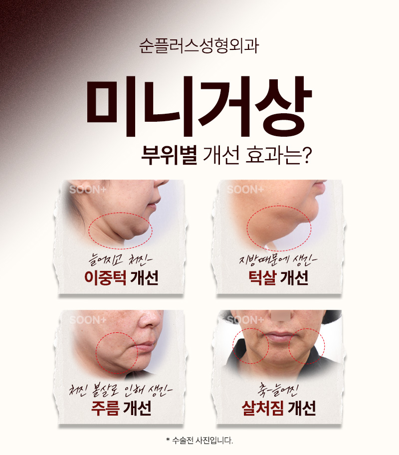 Mini Facelift Incisions Are Small, but the Results Are Not image 4