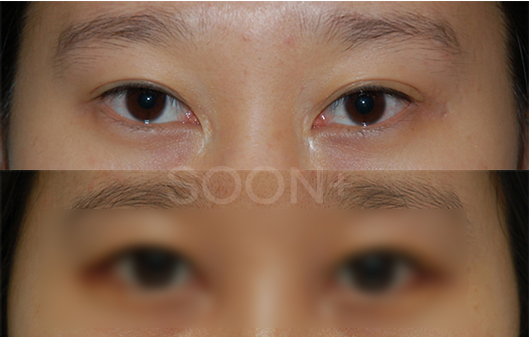 The approach to revision outer corner surgery varies depending on the cause image 4