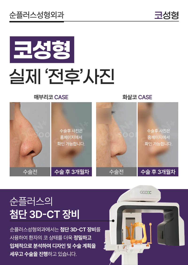 짧은코 낮은코도 비율에 맞춰 입체감있는 코수술 관련 이미지 5