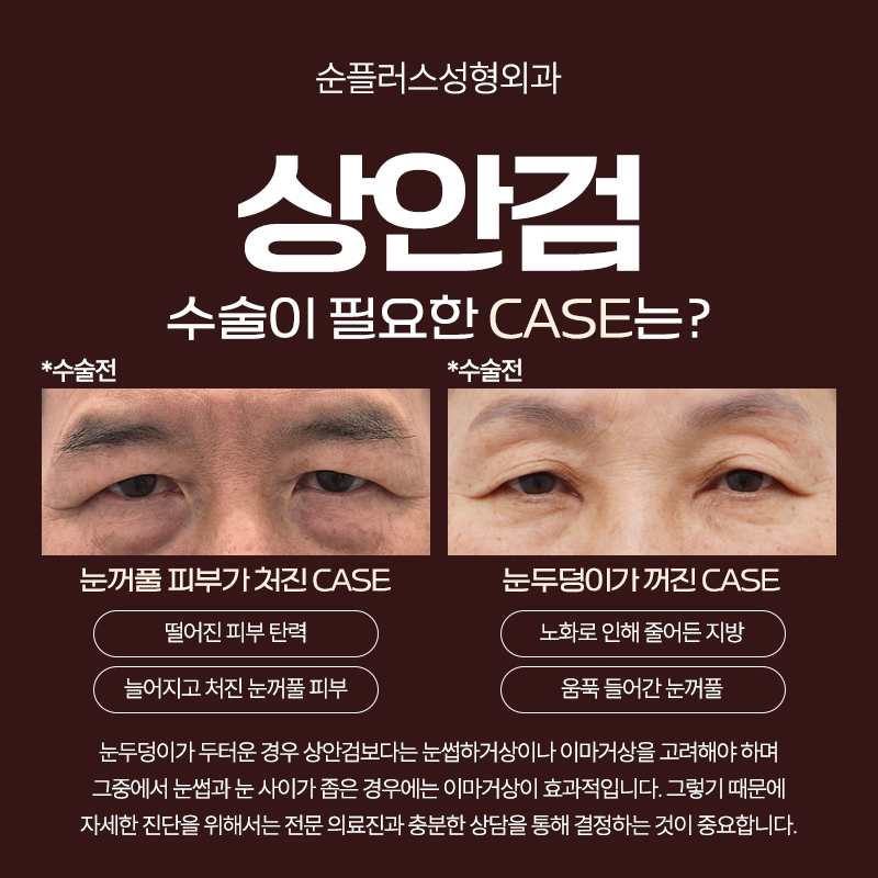 상안검수술 단순 처진눈꺼풀 수술이 아닌 기능과 구조를 파악해 관련 이미지 4