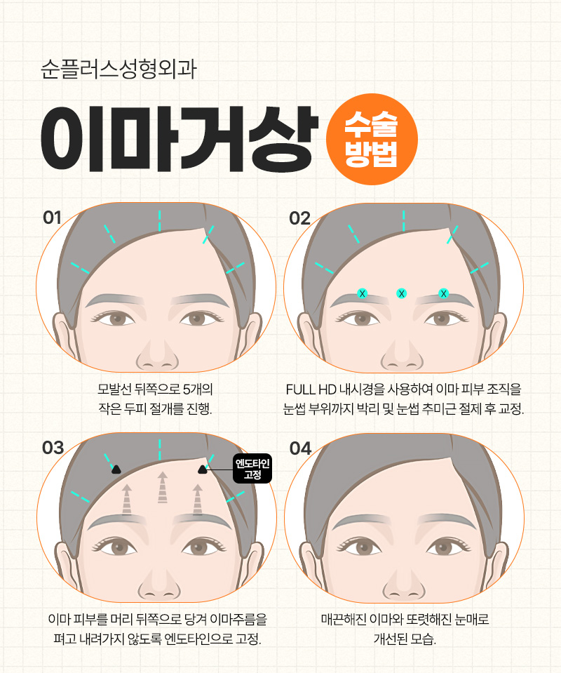 답답한 눈매의 원인, 이마처짐. 내시경 이마거상술로 개선? 관련 이미지 5