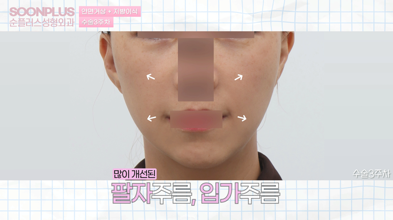 안면거상 지방이식 병행시의 안면거상효과 관련 이미지 2