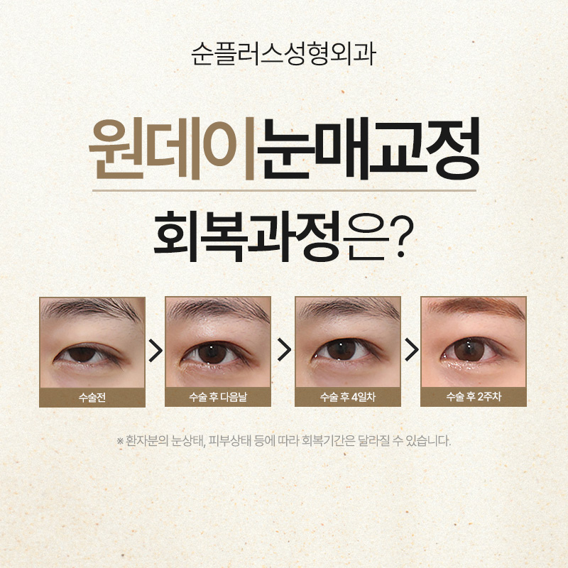 졸린눈 교정, 하루만에 개선된다면? [원데이눈매교정] 관련 이미지 4