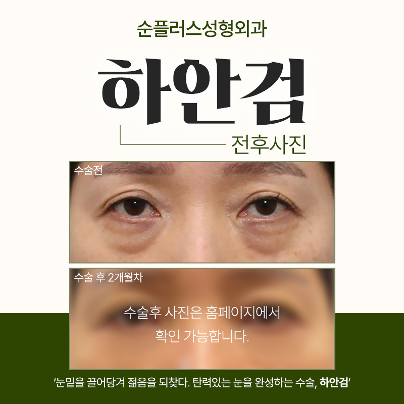 하안검수술잘하는곳 늘어짐은 사라지고 인상 밝게 관련 이미지 4