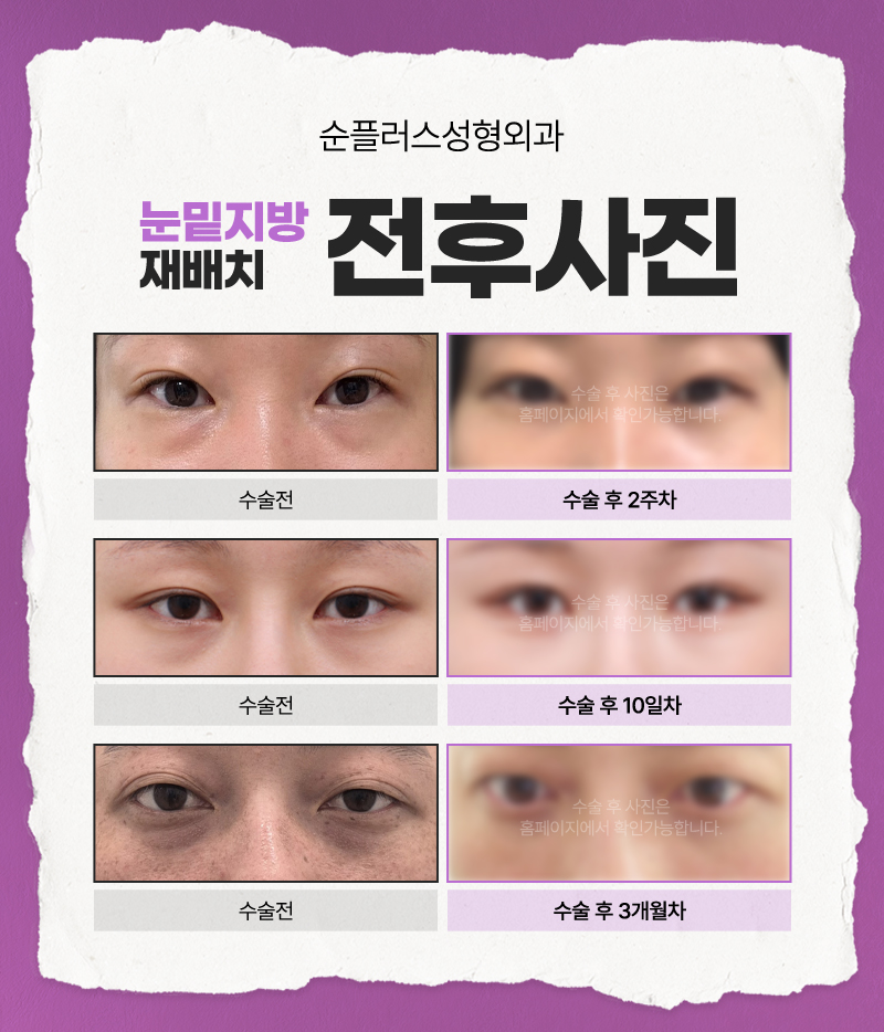 눈밑지방재배치잘하는병원, 결과 차이를 만드는 병원 선택 기준 관련 이미지 5