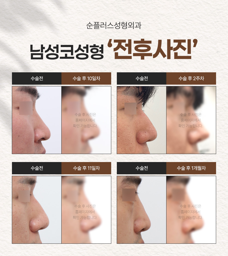 남자코성형잘하는곳 올바른 선택을 위해 관련 이미지 4