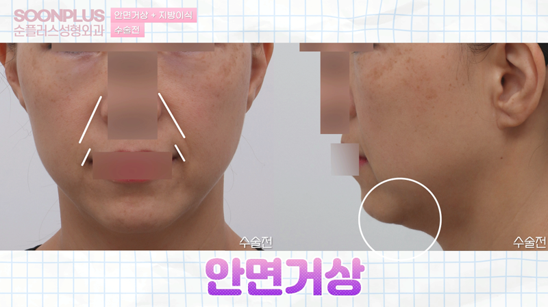 안면거상 지방이식 병행시의 안면거상효과 관련 이미지 1