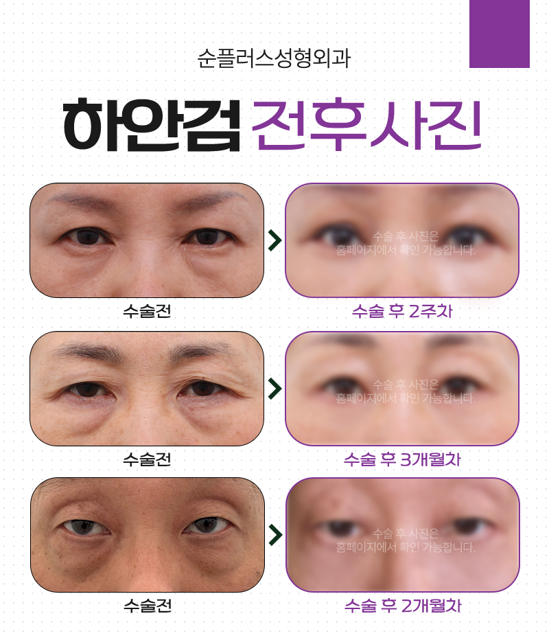 중년의 두툼한 눈밑 변화를 위한 하안검성형. 관련 이미지 5