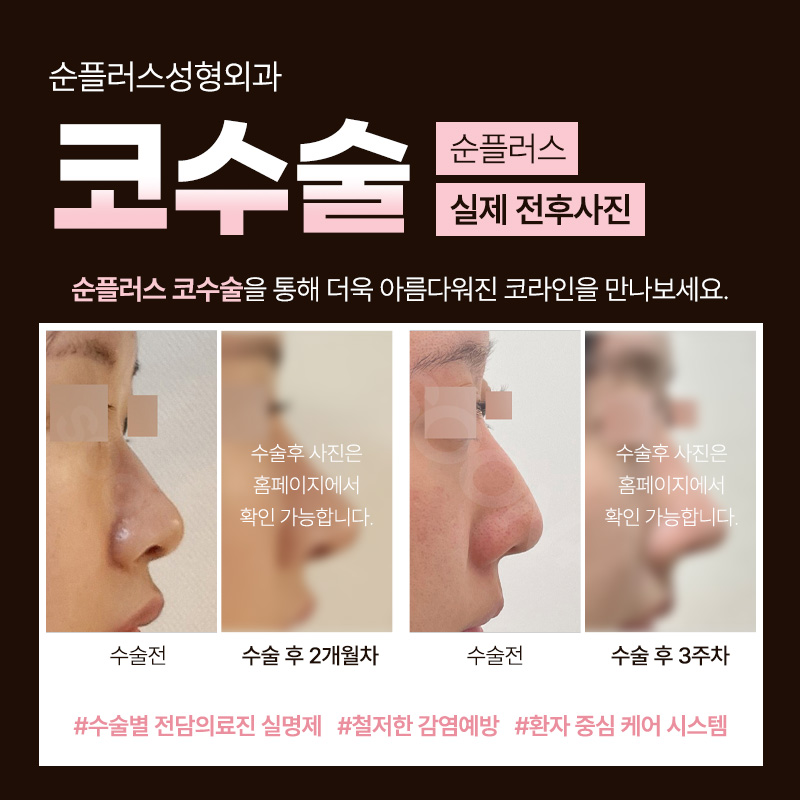 코성형수술 세밀한 분석을 통해 관련 이미지 5