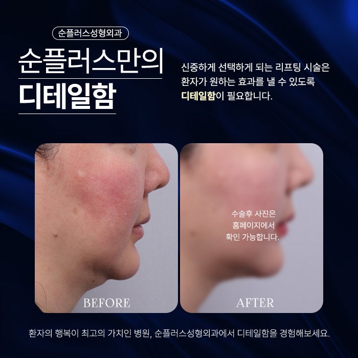 실리프팅병원 꼼꼼하게 알아본후 관련 이미지 6