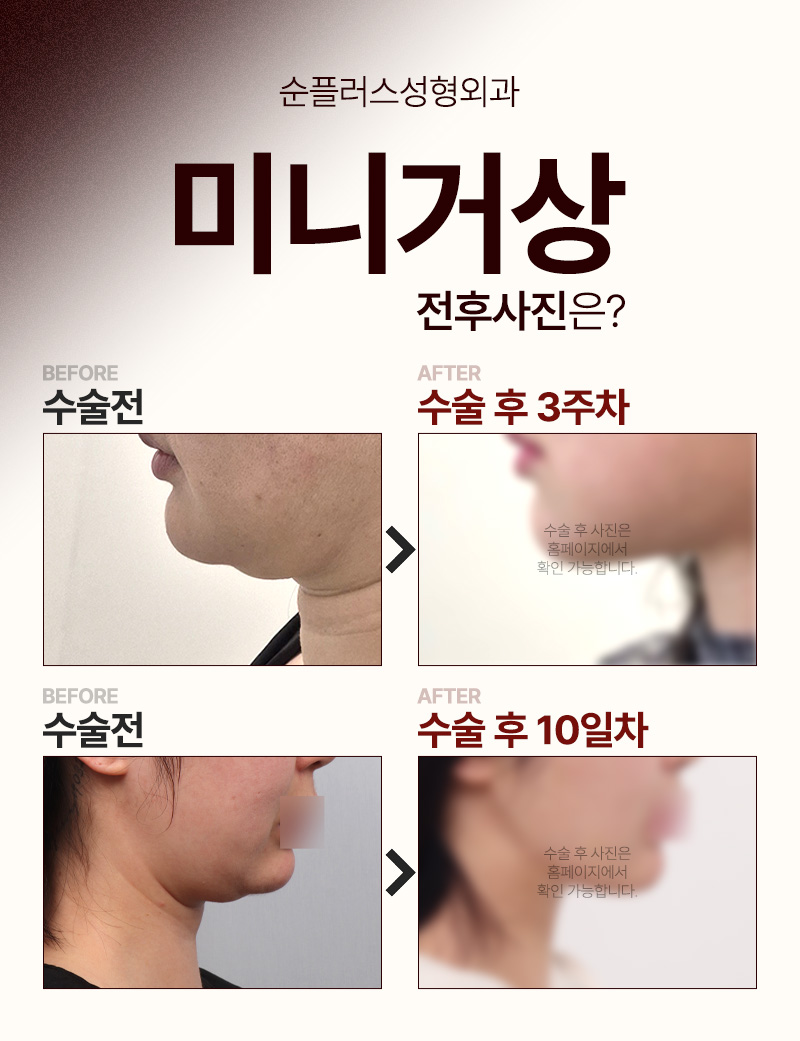 Mini Facelift Incisions Are Small, but the Results Are Not image 6