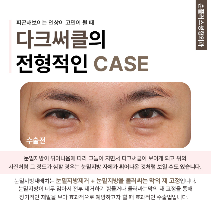 What Makes a Good Under-Eye Fat Repositioning Clinic Different image 3