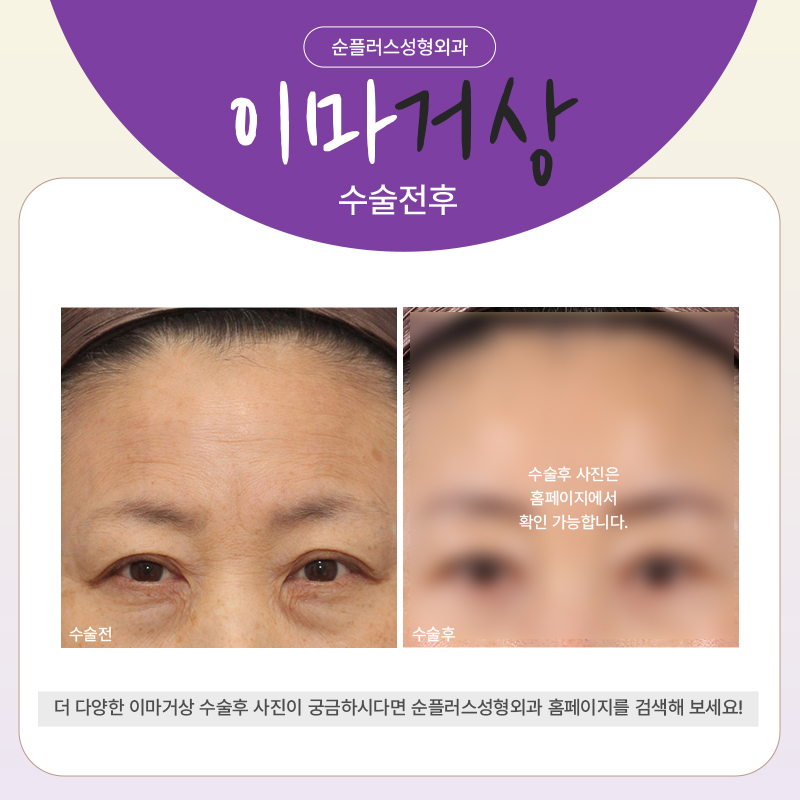 If the Cause of Eyelid Ptosis Surgery Is Forehead Skin Sagging image 5