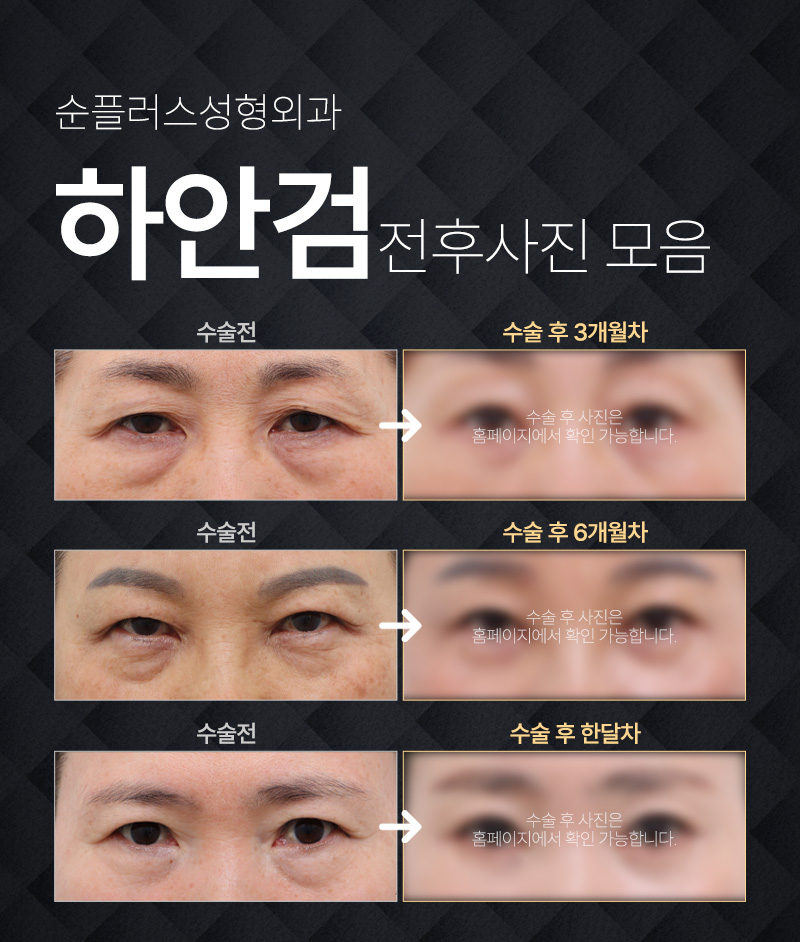 하안검재수술도 원인에 맞는 플랜으로 관련 이미지 6
