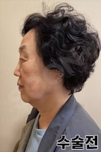 The Degree and Direction of Tension at a Clinic That Specializes in Facelifts image 6