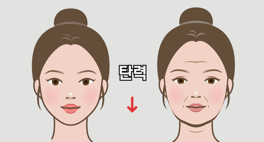 윤곽수술 후 리프팅 혹은 살처짐 개선 리프팅 방법은 관련 이미지 2