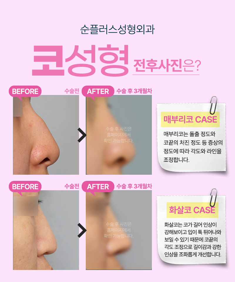 코성형, 얼굴 밸런스를 완성하기 위한 관련 이미지 4