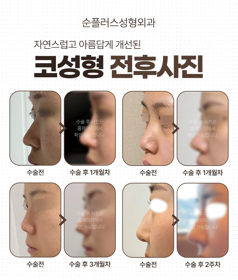 Checklist for a Primary Nose Surgery: From Material Selection to Cost, Recovery Period, and Precautions image 6