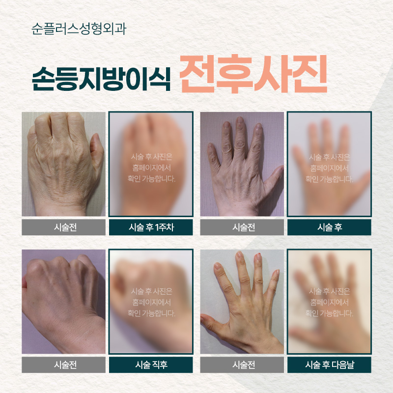 울퉁불퉁 자글자글한 손등 주름, 힘줄, 혈관에 자연스러운 볼륨으로[손등지방이식] 관련 이미지 4