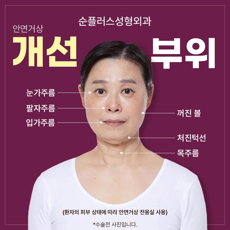 About the Effects of Facelift Surgery, Scarring, and Recovery Time image 4
