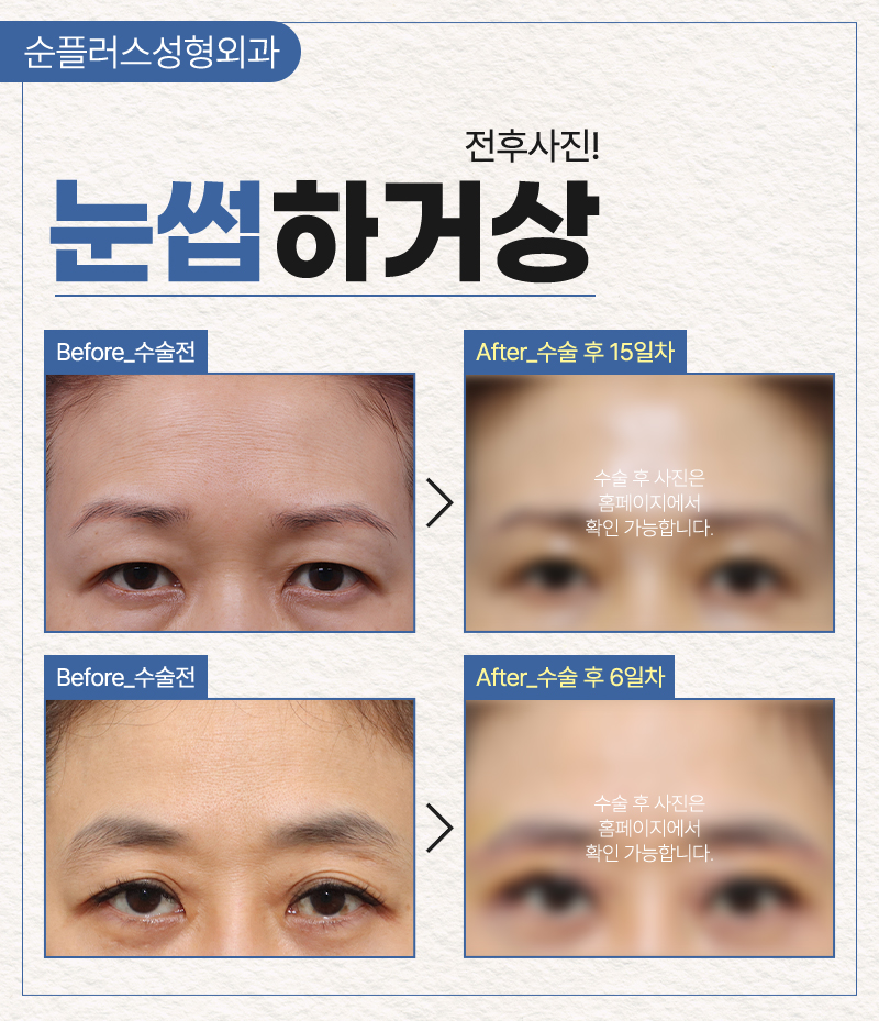 눈과 눈썹사이가 멀고 눈매가 답답해 보인다면 눈썹하거상술로 개선의 기대를 관련 이미지 6