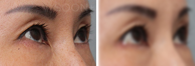 The approach to revision outer corner surgery varies depending on the cause image 3
