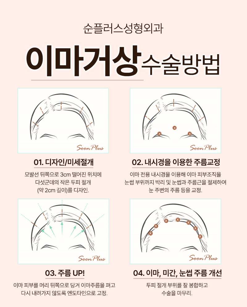 내시경이마거상 이마주름 미간주름 매끈하게 관련 이미지 5