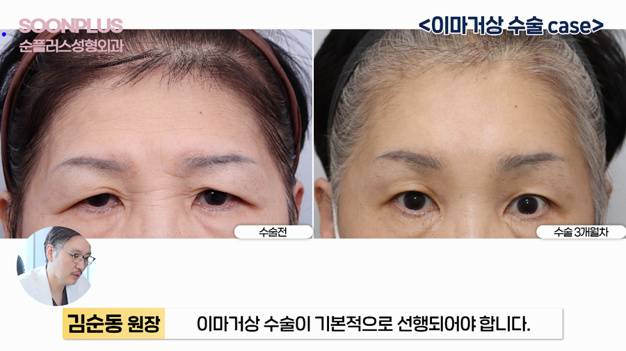What Surgery Is Performed to Improve Drooping Eyelids and Sagging Eyes, Even by Celebrities? image 7