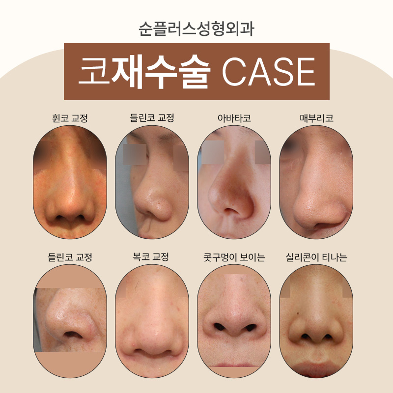 코재수술성형외과 비율과 균형을 고려해 관련 이미지 5