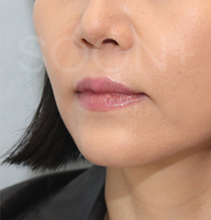 경계가 불분명한 턱끝, 무턱수술 플랜이 필요할때 관련 이미지 7