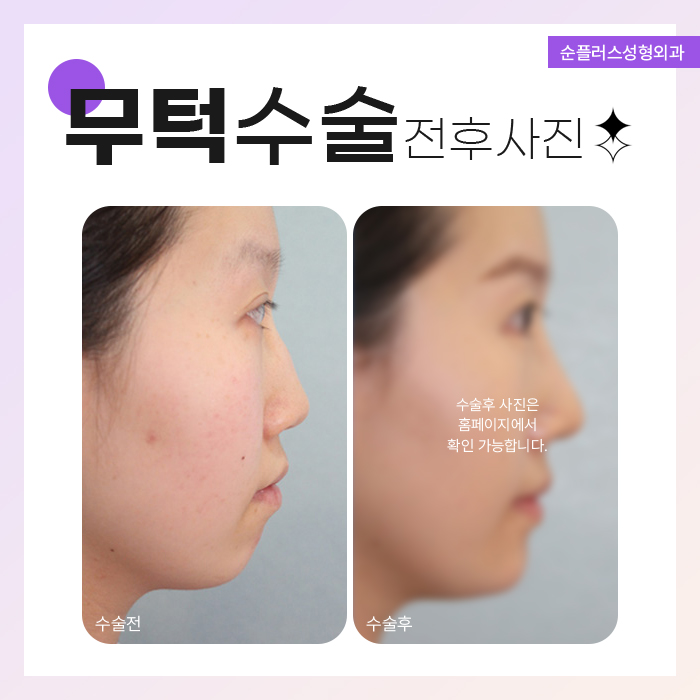 무턱수술잘하는곳 환자별 디자인도 다르게 관련 이미지 6
