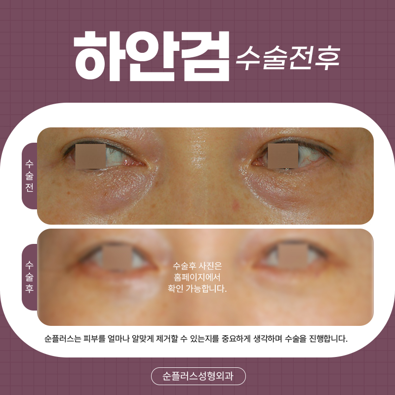하안검수술잘하는곳 불룩한 눈아래 관련 이미지 5