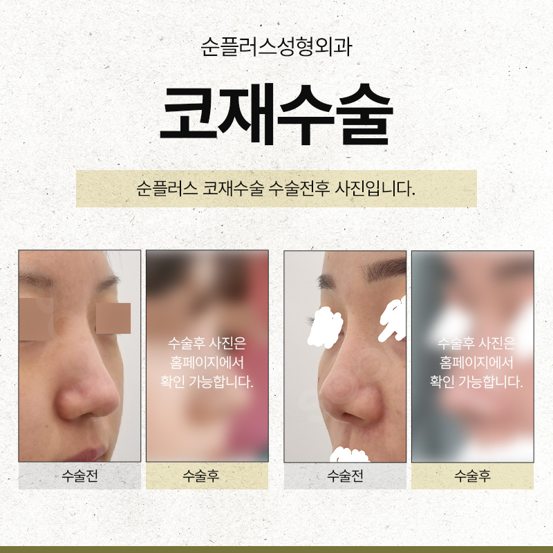 강남코재수술 선호하는 유형에 따라 관련 이미지 6