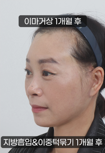 50대 안면거상 이마거상 지방이식으로 동안의 효과를 관련 이미지 4