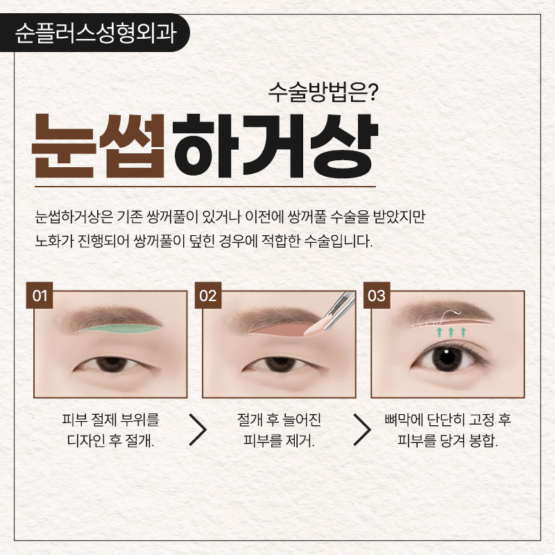 Brow Lift Surgery to Raise Sagging Eyelids and Improve the Eye Shape image 3