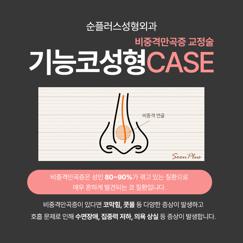 기능코수술 비염 등의 기능적 개선에 콧대 라인까지 관련 이미지 3
